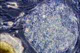 New stem cell therapy succeeds