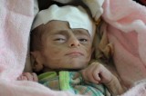 One Million Yemeni Children Suffer Malnutrition